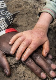 Photo: Two hands, one adult and dark-brown, one child-size and albino, laid across one another on a mound of dirt.