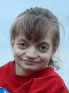 Photo of Brianna Gussert, a teenage girl with pale skin and brown hair, wearing a red shirt. She has the characteristic wide nasal bridge of Wolff-Hirschhorn syndrome.