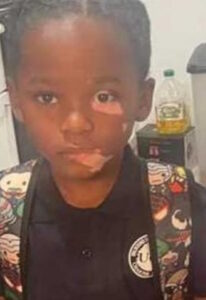 Photo of a young boy with black hair and dark-brown skin, wearing a black polo shirt and a backpack. Some spots of vitiligo are visible on his face, lightening skin under his mouth and one eye.